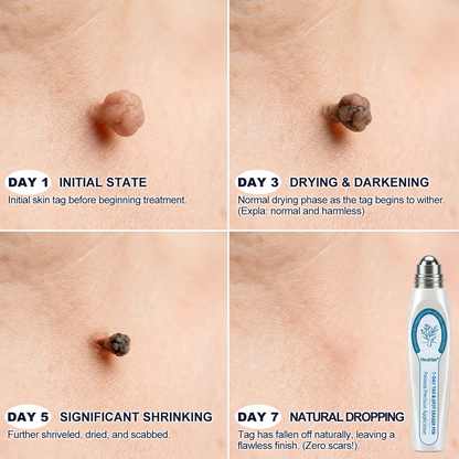 𝐇e𝐚𝐥𝐫i𝐳e®🇺🇲🎄7-𝐷𝑎𝑦 𝗧𝐚𝐠 & 𝗦𝗽𝐨𝐭 𝐄𝐫𝒂𝒔𝒆𝒓(Zero Pain, Zero 𝐒𝐜𝐚𝒓𝒔 Rollerball)